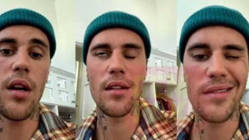 Apakah kaitan antara cacar air & kelumpuhan muka dialami Justin Bieber? Adakah anda berisiko? Apakah kaitan antara cacar air & kelumpuhan muka dialami Justin Bieber? Adakah anda berisiko?