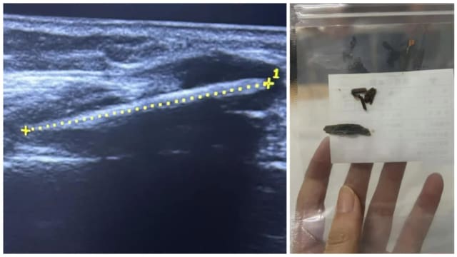 中国女子走路一久就痛 照X光发现竹签扎小腿16年  