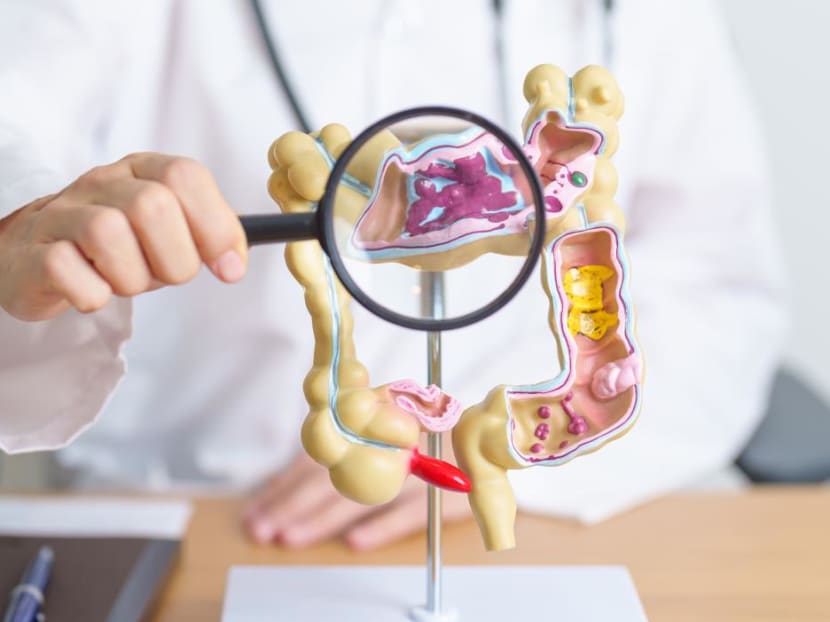 Why are more millennials getting colorectal cancer despite healthy lifestyles? Should you get a colonoscopy?