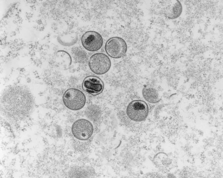 Monkeypox cases will be given isolation orders and can recover at home from Aug 22: MOH