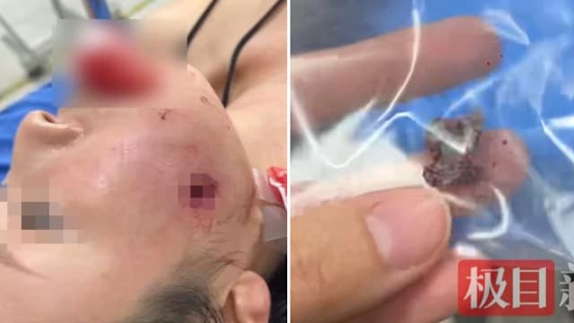 普吉岛射击场拍照 中国游客被流弹击穿脸