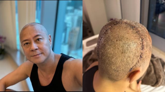 完成脑部肿瘤切除手术　草蜢蔡一杰IG报平安