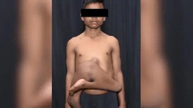 腹部长寄生双胞胎17年 印度少年接受切除术获新生