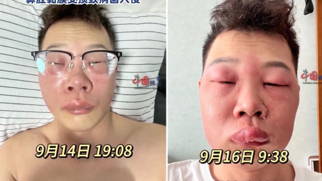 平时爱抠鼻子 北京男子脸肿到睁不开眼