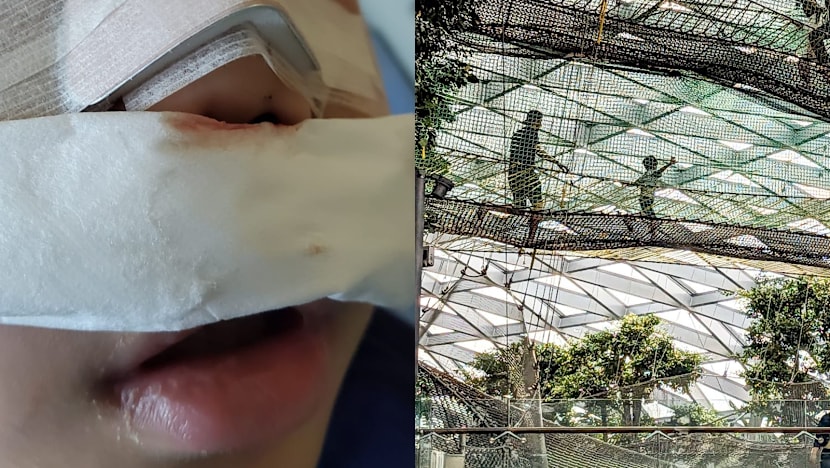 Boy fractures nose at Jewel walking net attraction; BCA and operator urge visitors to follow safety rules and supervise children