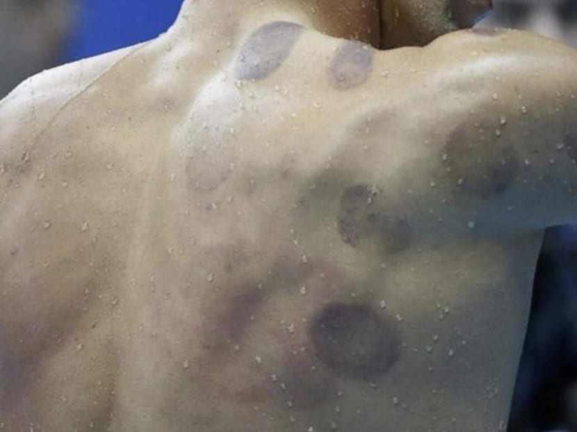 Cupping marks on American swimmer Michael Phelps' back in 2016.
