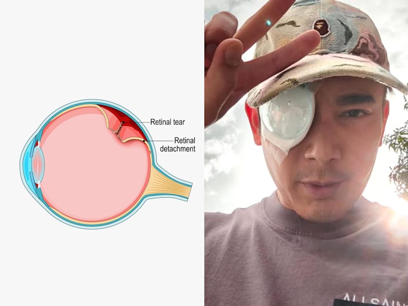 Elvin Ng’s eye surgery: Retinal detachment, myopia and the warning signs you should not ignore