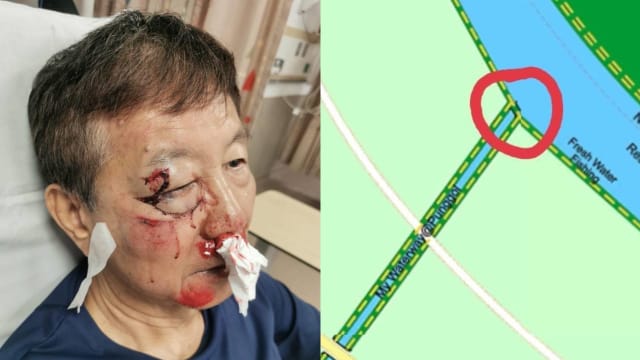 七旬伯公园连道骑脚踏车遭野猪袭击 颧骨多处骨折