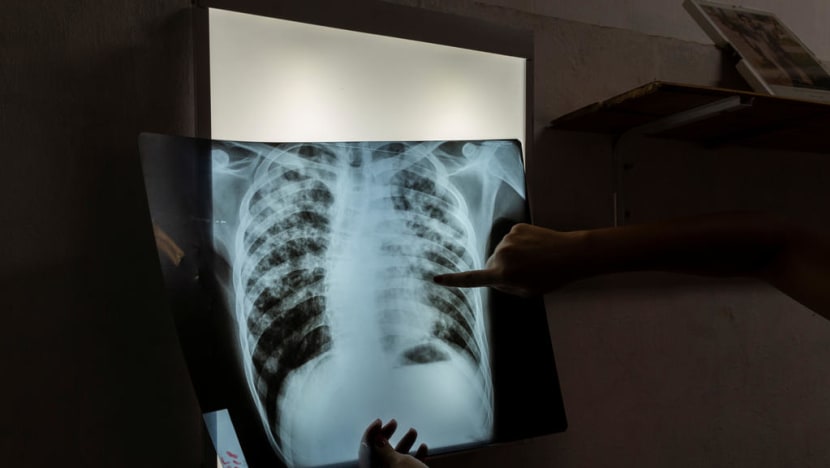 Slight drop in active tuberculosis cases in Singapore in 2020: MOH