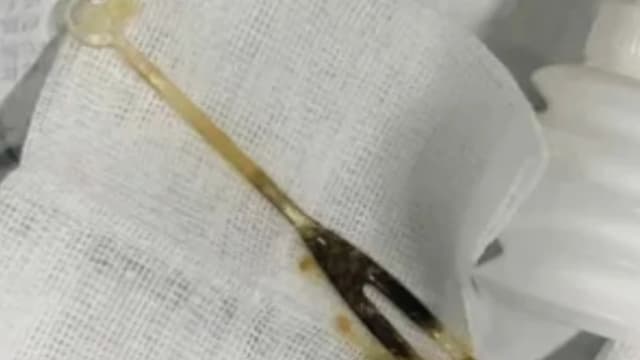 中国男子腹痛开刀 医生从肠里取出叉子
