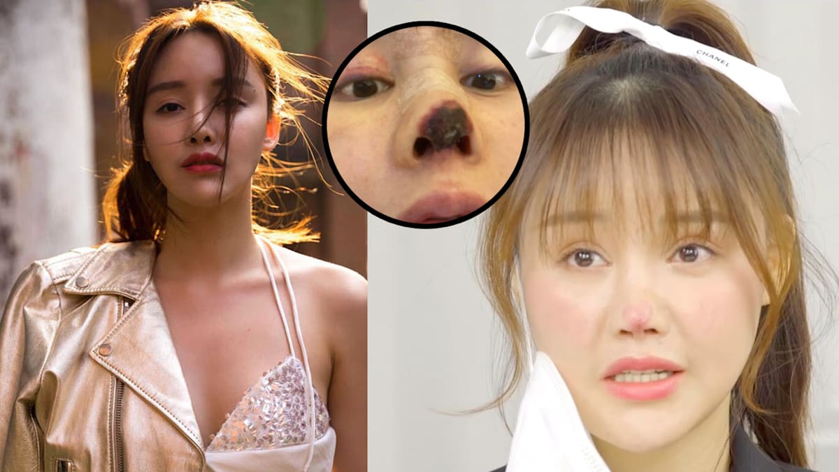 Chinese Actress Gao Liu Whose Nose Turned Black After A Botched Nose chinese-actress-gao-liu-whose-nose-turned-black-after-a-botched-nose