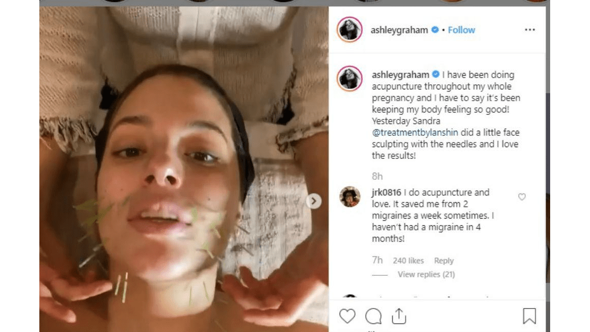 Ashley Graham has facial acupuncture - 8days