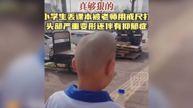 中国小学生丢失课本 被老师用戒尺打头变形