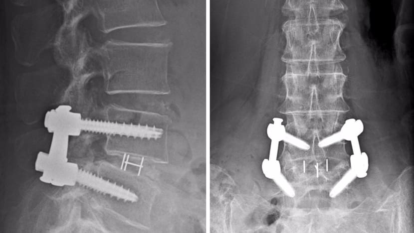 Keyhole spine surgery saved 79-year-old’s back – and sanity