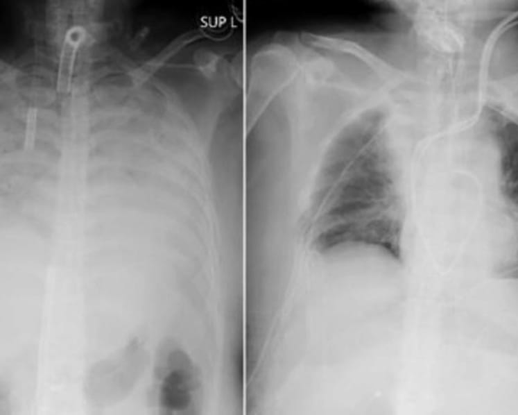 COVID-19 patient in Japan receives lung transplant from living donors