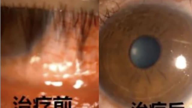 中国男子感染性病 疑是酒店毛巾惹的祸