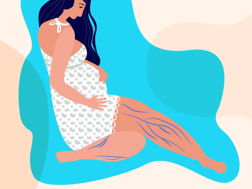 Varicose veins aren&rsquo;t just unsightly but could also be a health risk &ndash; why do women still ignore them?