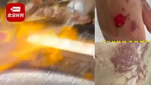 中国女子用餐被明火烧伤 餐厅：她为拍视频要求加酒精