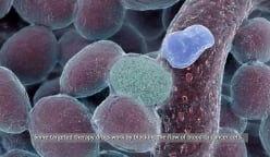 Colorectal Cancer