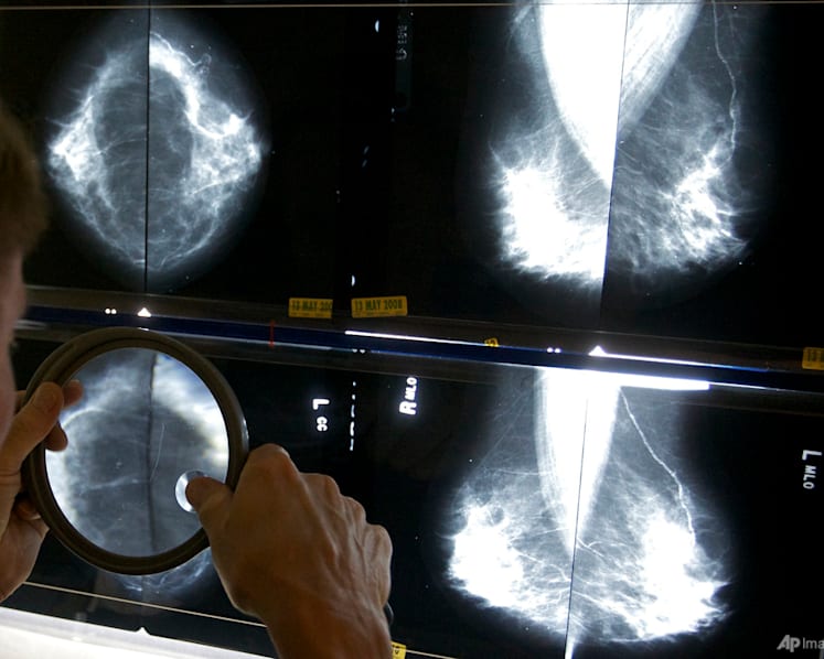 Commentary: AI improves breast cancer detection, but will that save lives?