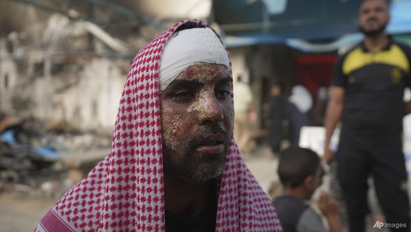 Burned Palestinian's relatives describe aftermath of Israeli attack Burned Palestinian's relatives describe aftermath of Israeli attack