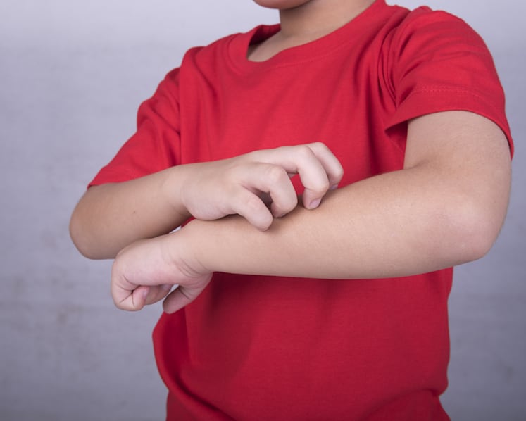 The hidden price of childhood eczema