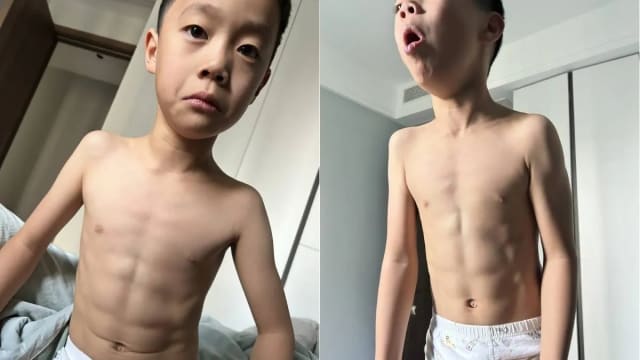 中国男童咳嗽十天 竟然咳出八块腹肌