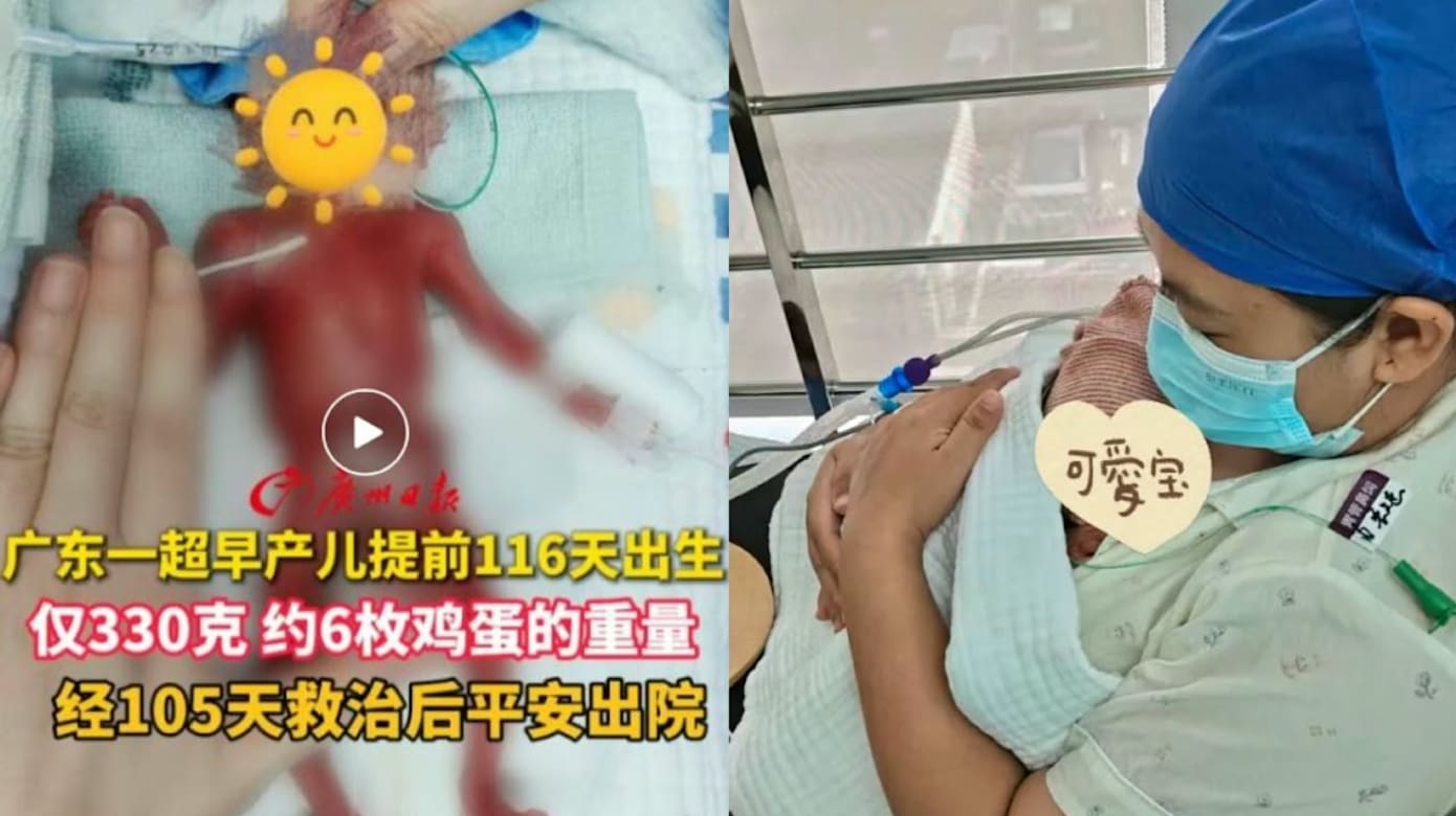 中国女子怀孕五月产330克巴掌大婴儿 经105天抢救平安出院