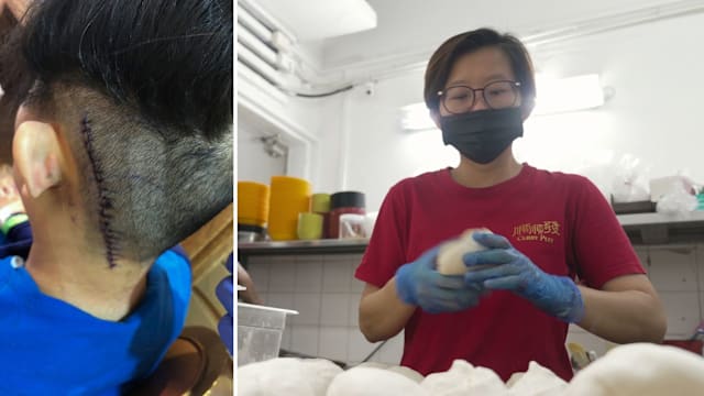 切除脑瘤左耳失聪经历婚变 单亲妈选择坚强面对人生