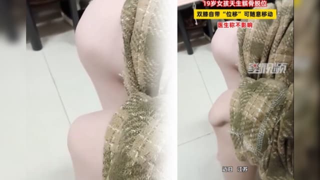 江苏女孩天生髌骨脱位  称双膝盖可随意移动