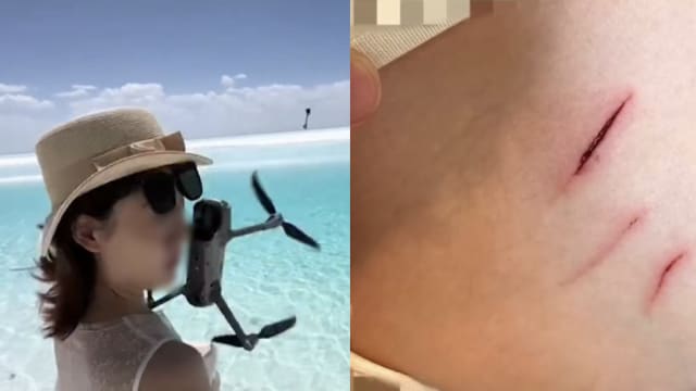 中国女子湖边拍照 遭无人机撞伤脸