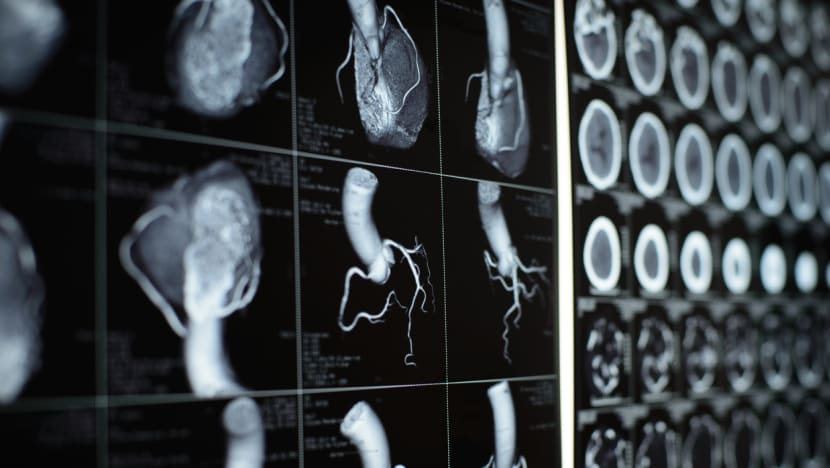 Commentary: Long COVID patients are much more likely to have multiple organ abnormalities Commentary: Long COVID patients are much more likely to have multiple organ abnormalities