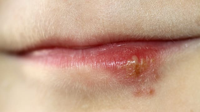 嘴角起泡误当上火 中国女子高烧呕吐后脑死