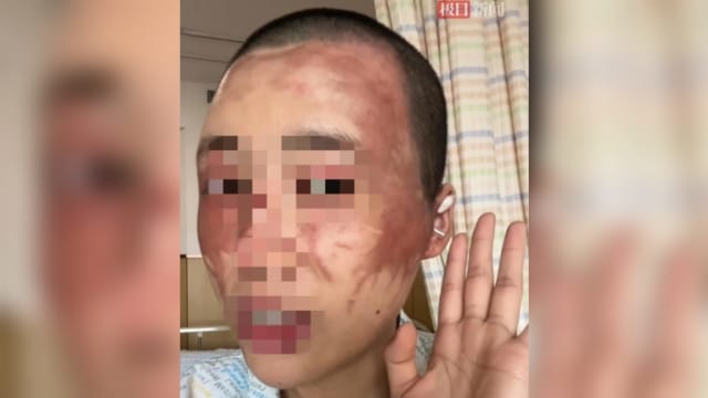 中国妇女不想生第二胎 丈夫竟向她泼硫酸