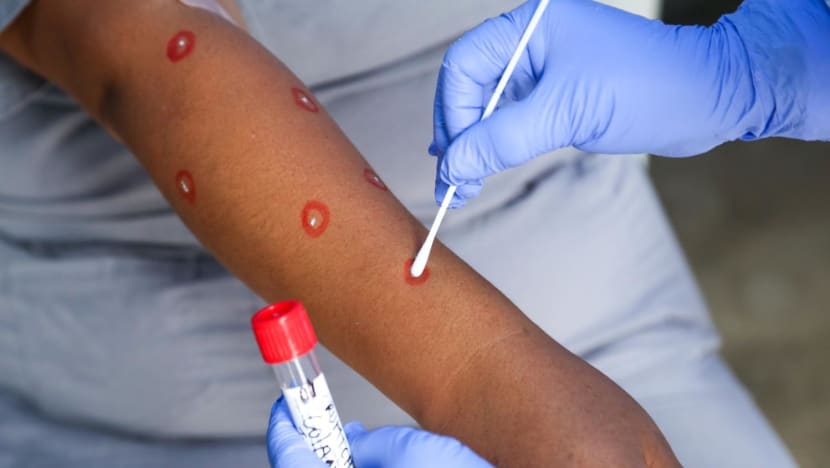 Singapore reports 11th case of monkeypox infection 