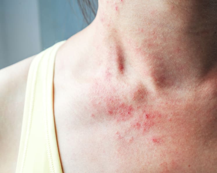 Living with severe eczema: Lost sleep, blood on clothes, mental health struggles