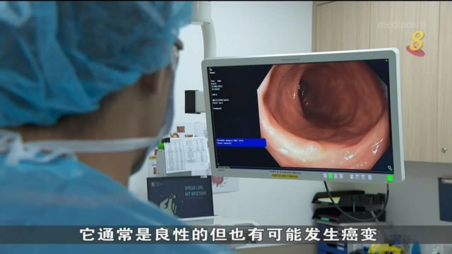盛港综合医院引进人工智能内窥镜技术 提高结肠癌检测准确性