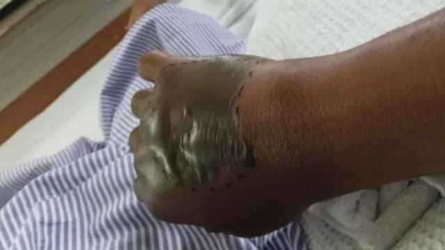 毒蛇藏鞋架咬人 马国男子手部发黑紧急送医