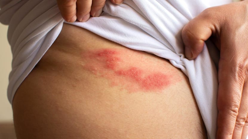 Shingles: More than a rash, a painful condition not to ignore 