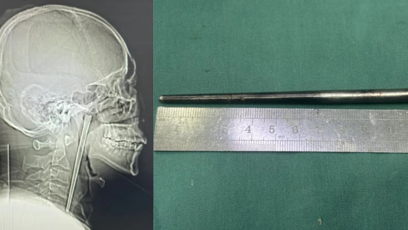 Man Lives With 12cm Metal Chopstick In Throat For 8 Years