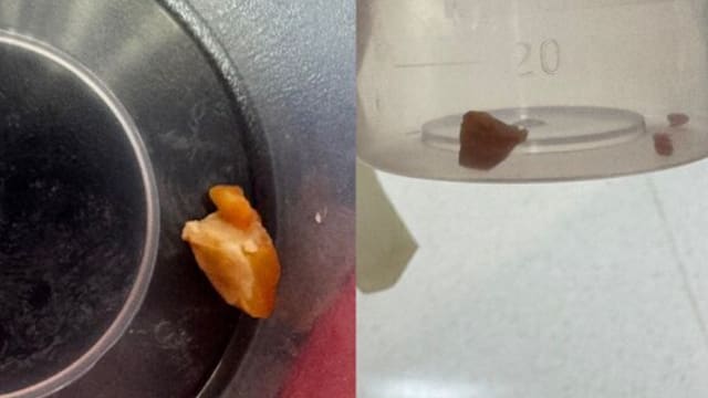 奶奶喂整颗花生卡气管 一岁童咳到肺开始塌陷