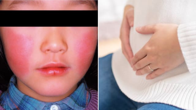 日本“苹果病”肆虐 孕妇孩童受促避免去疫区