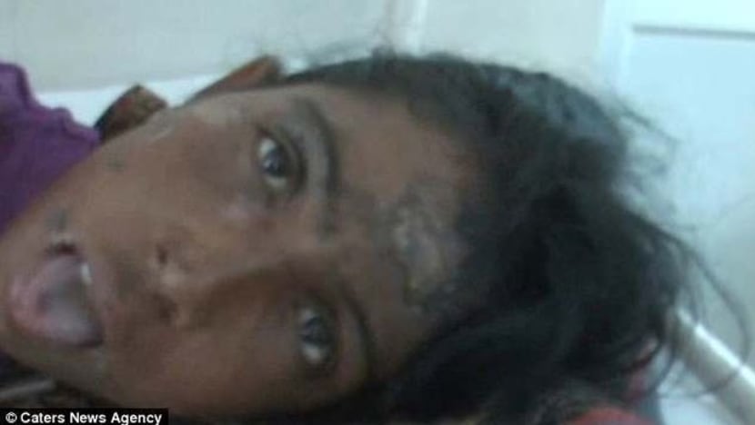 Ingin halau hantu, 'bomoh' cucuh mulut wanita dengan besi panas