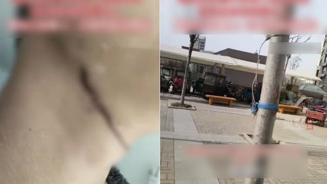 居民私自拴晾衣绳 中国男子骑车经过被割喉受伤  