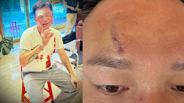 阿Ben拍戏受伤“白衣染血”！额头缝数针仍乐观：眼睛眉毛都没事