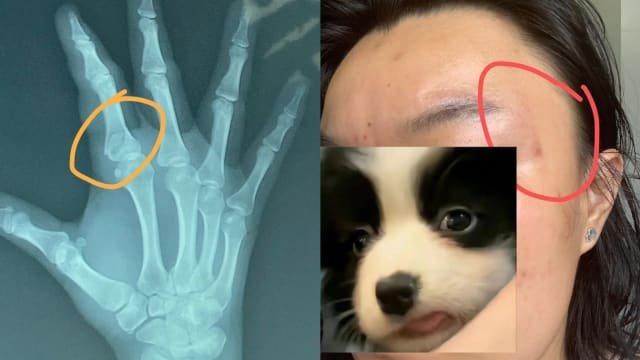 疑不满对方用力关车门 马国司机殴打中国留学生致骨裂