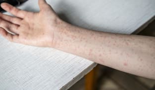 CNA Explains: Is Singapore at risk of a measles comeback?
