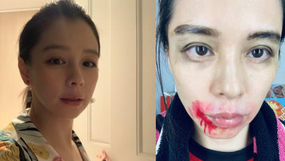 Vivian Hsu Is Not A Victim Of Domestic Violence, Despite What Her Recent Photo Suggests
