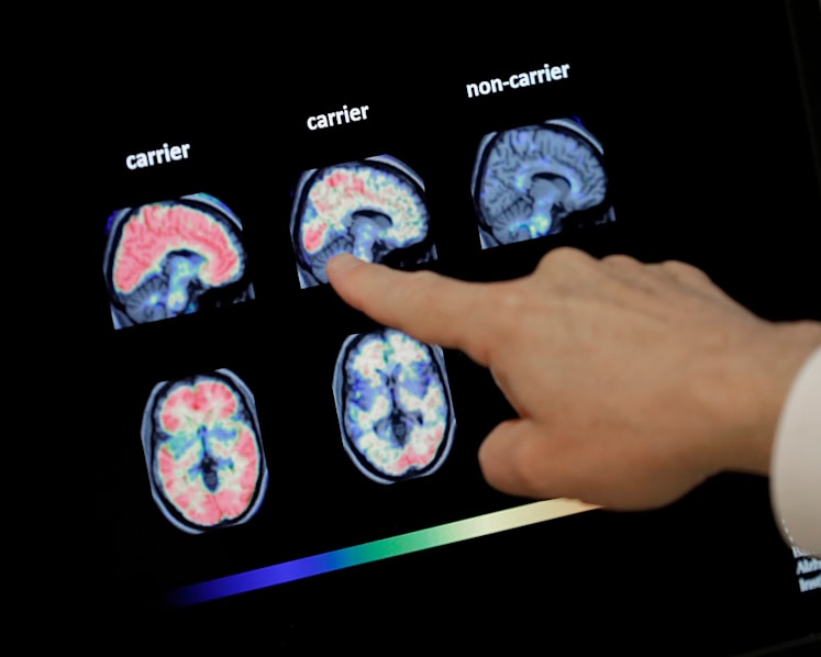 Commentary: Fighting dementia could be as easy as the shingles vaccine