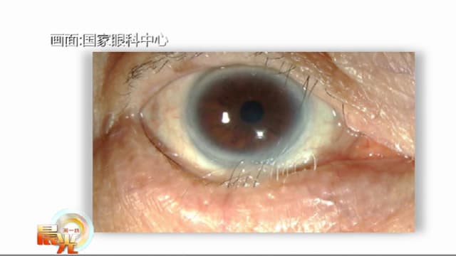 晨光|善方保健：逆生长反伤眼球 睫毛倒插怎么治？